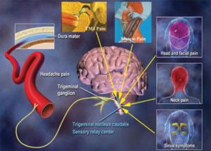 Headaches and Migraine - Head Pain Institute